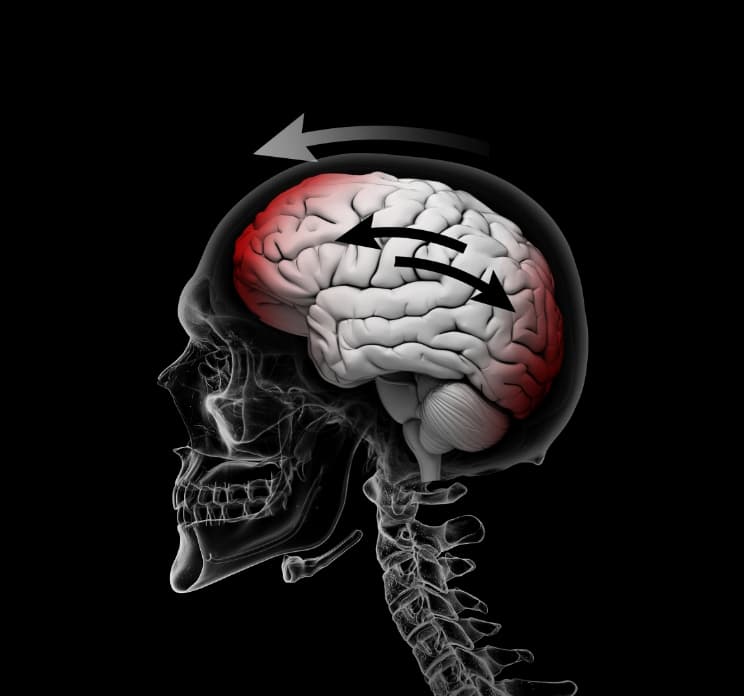 Vibration Brain Injury